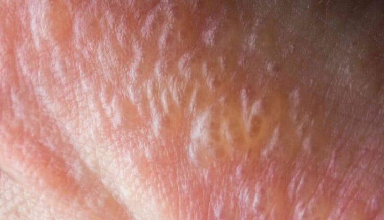 cậu nhỏ nổi mụn trắng không ngứa