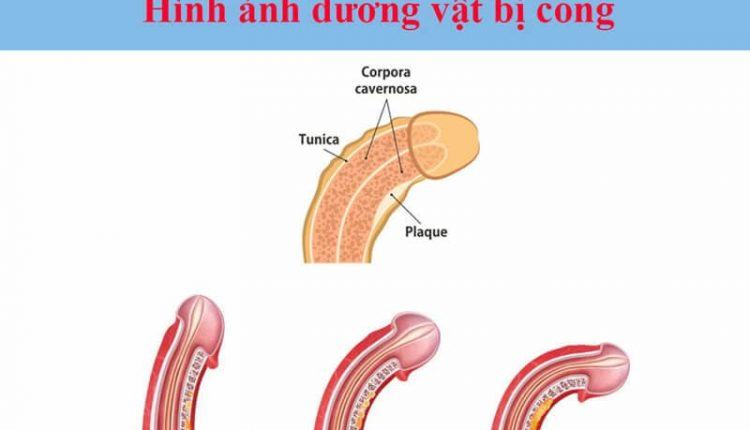 bài tập cho cậu nhỏ bị cong
