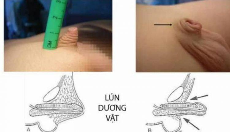 Hiện tượng thụt dương ở người lớn