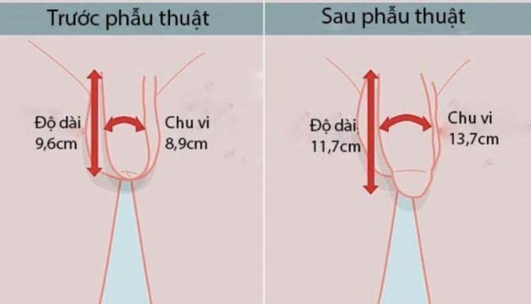 Phẫu thuật tăng kích thước dương vật